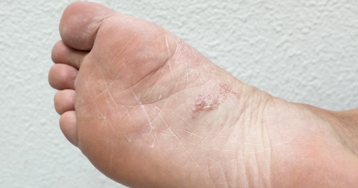 Athlete's Foot Symptoms or Dry Feet?